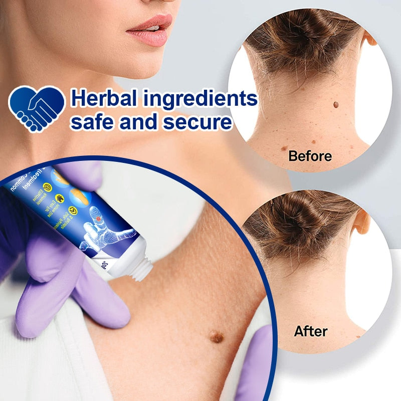 Instant Skin Tag Removal Mousse