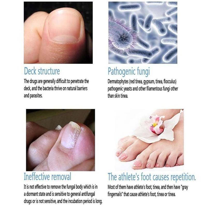 7-DAY Fungal Nail Repair Pen