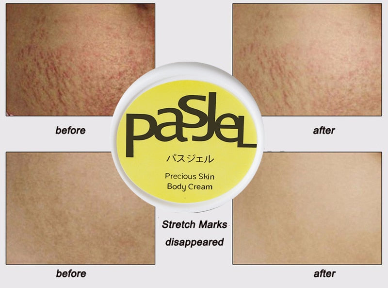 Skin Repair Cream For Stretch Marks & Scar Removal