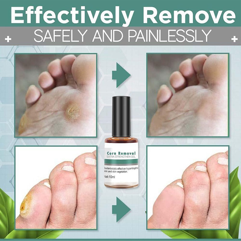 Corn Removal Extra Strengthen Gel